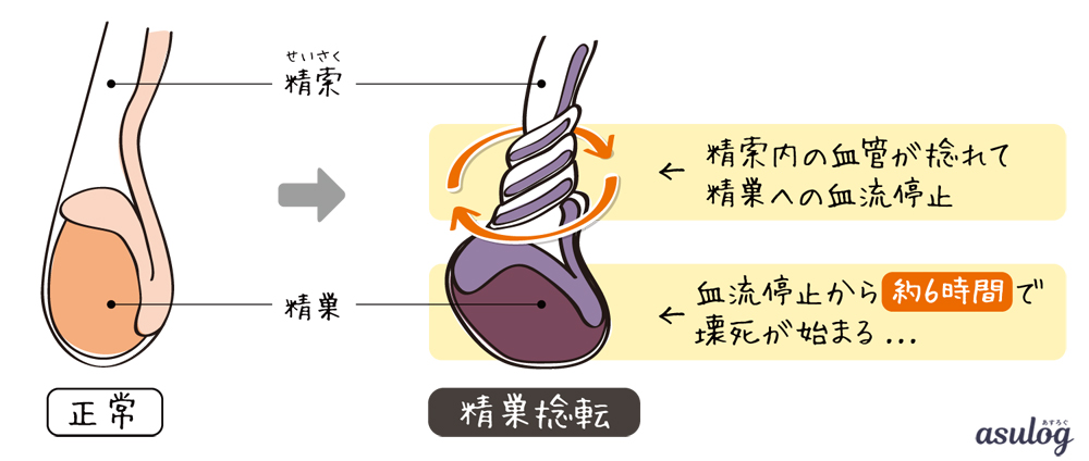 精巣捻転の原因は何ですか?